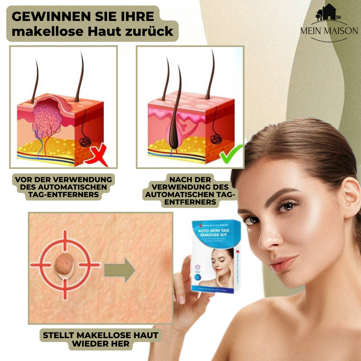 Lindegade | DermaLinx Vortefjerner | Smertefri Fjernelse af Vorter & Modermærker | Til Hjemmet | Uden Kirurgi