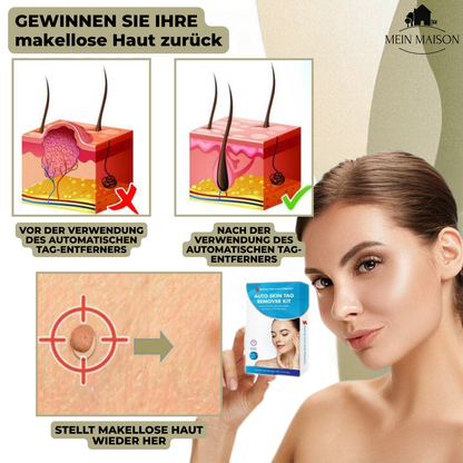 Lindegade | DermaLinx Vortefjerner | Smertefri Fjernelse af Vorter & Modermærker | Til Hjemmet | Uden Kirurgi