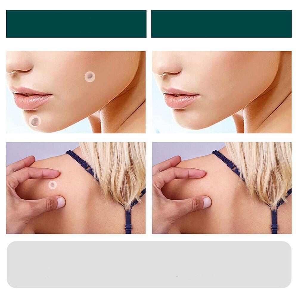SkinClear - Patches til fjernelse af pletter og vorter Lindegade