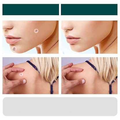 SkinClear - Patches til fjernelse af pletter og vorter Lindegade