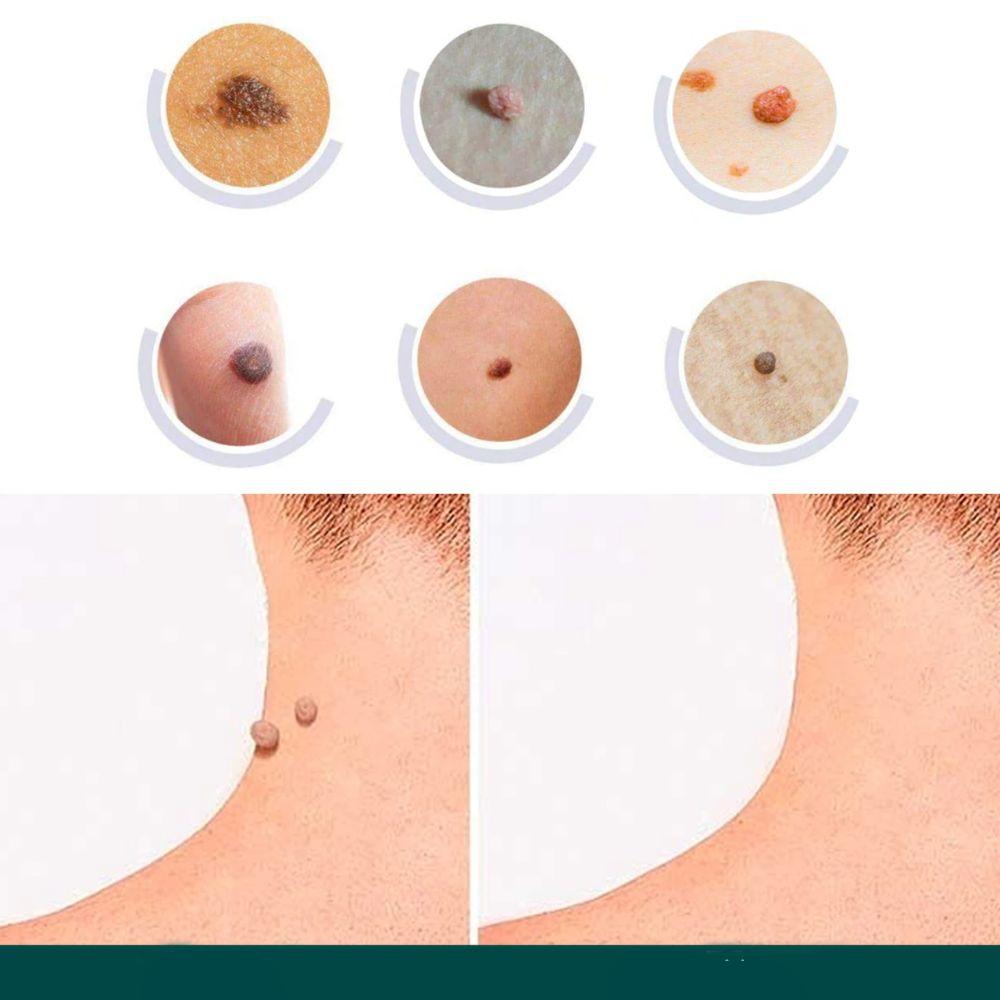SkinClear - Patches til fjernelse af pletter og vorter Lindegade
